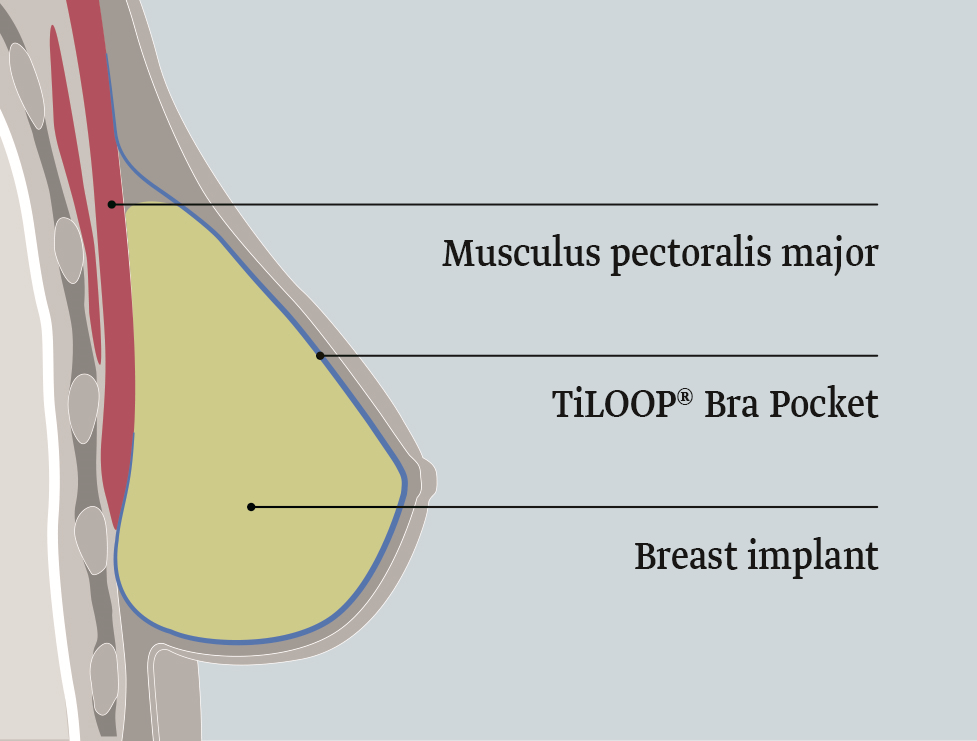 Malla Titanizada Prepectoral Tiloop Bra Pocket